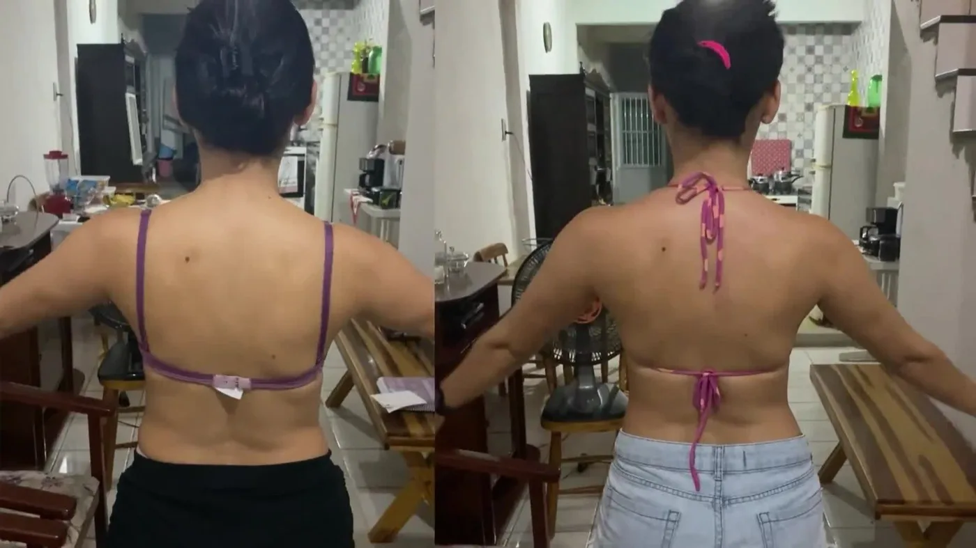 Vídeo clínico: discinesia escapular antes e depois de cinco sessões de fisioterapia