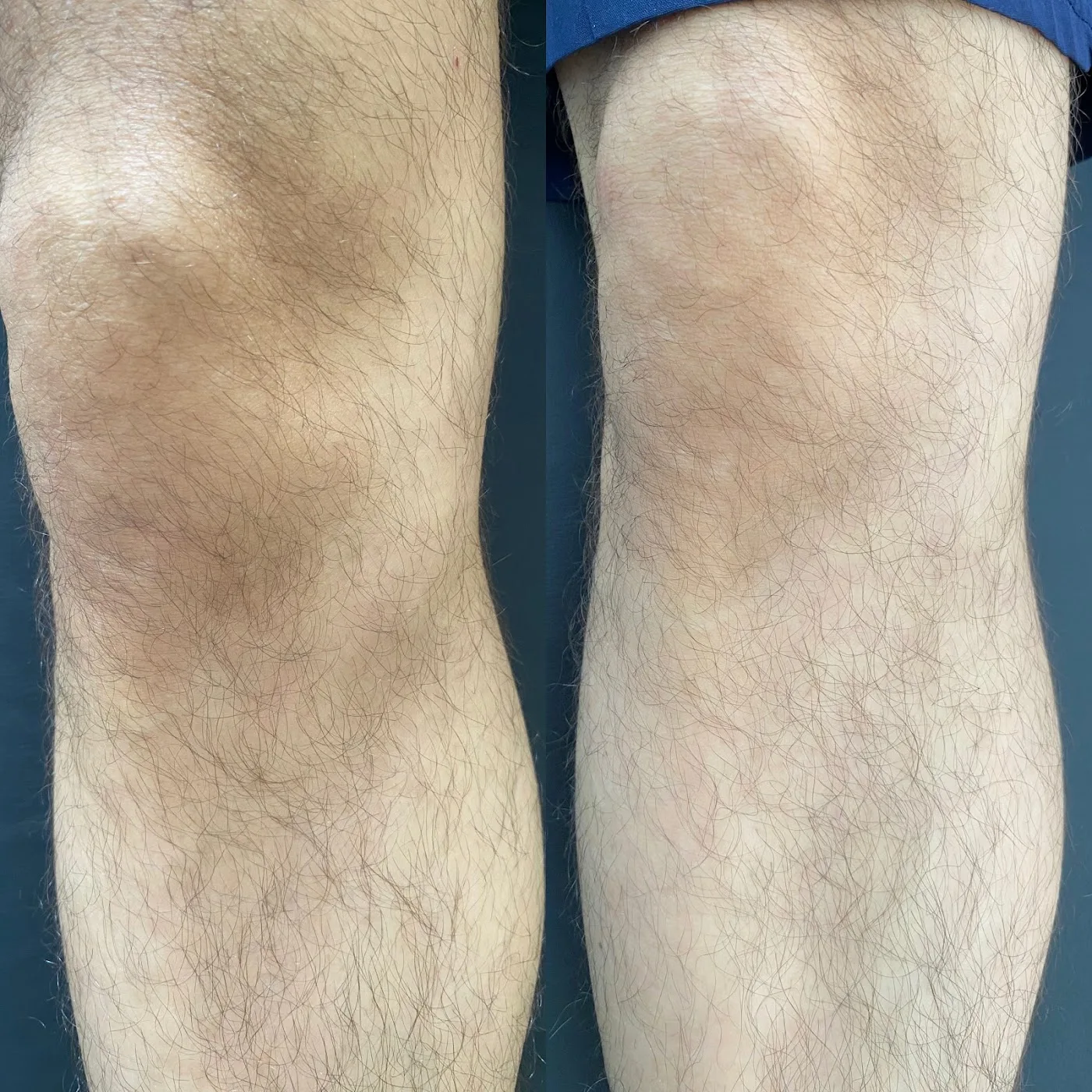 Registro clínico de edema ósseo na tíbia — evolução após protocolo de fisioterapia em Fortaleza